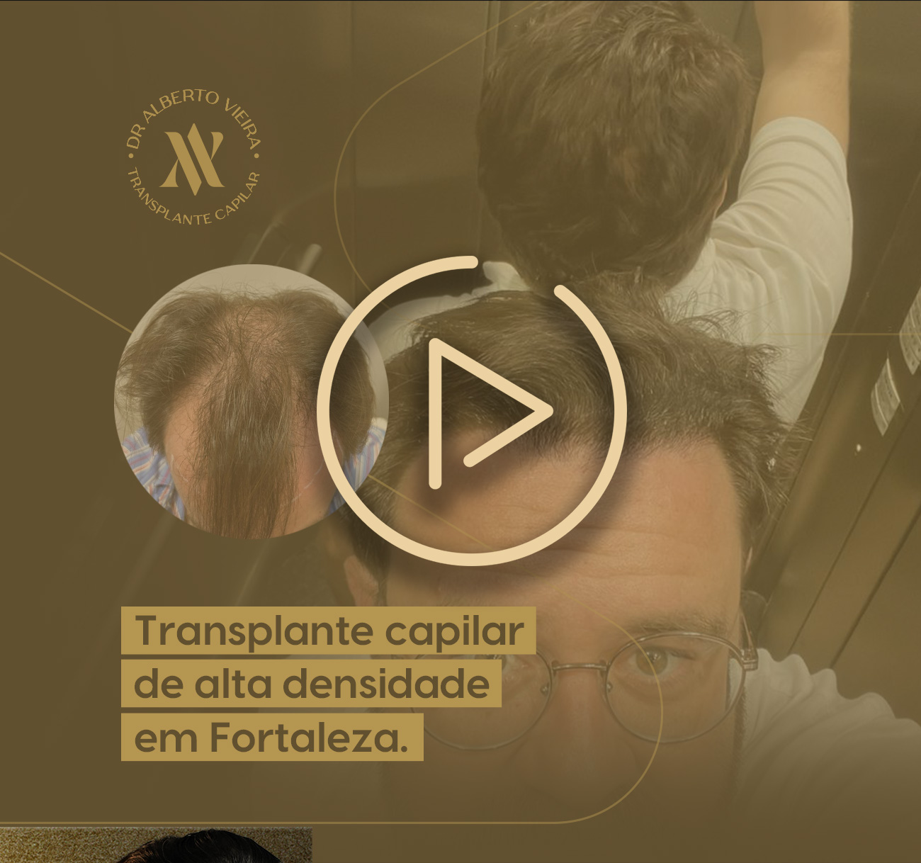 Transplante capilar de alta densidade em Fortaleza